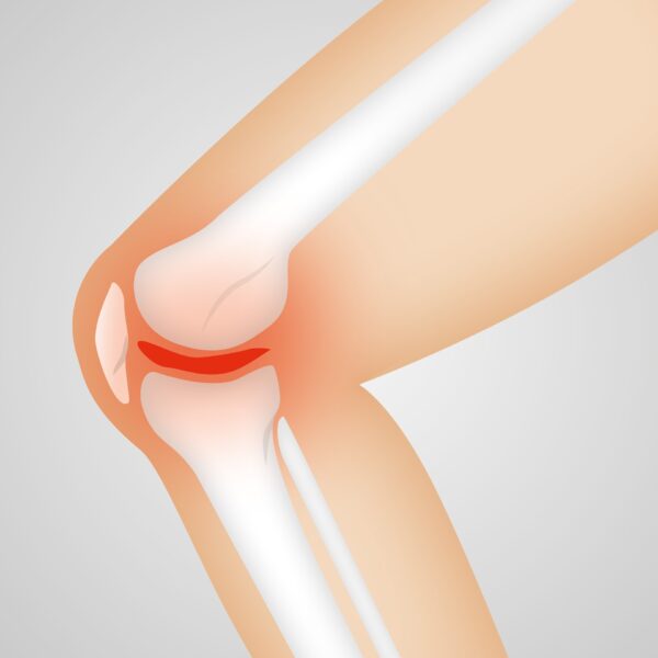 Osteoarthritis and Sports Injuries